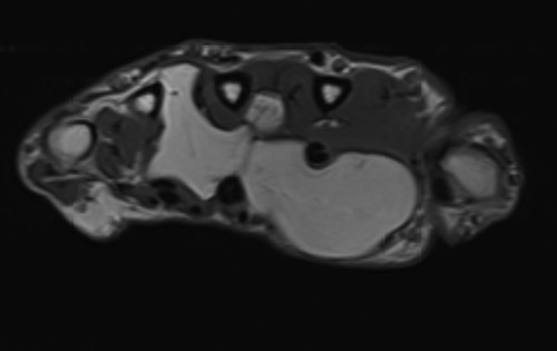 Axial MRI view demonstrating volar and dorsal extension of the fatty lesion from the middle of the palm.
