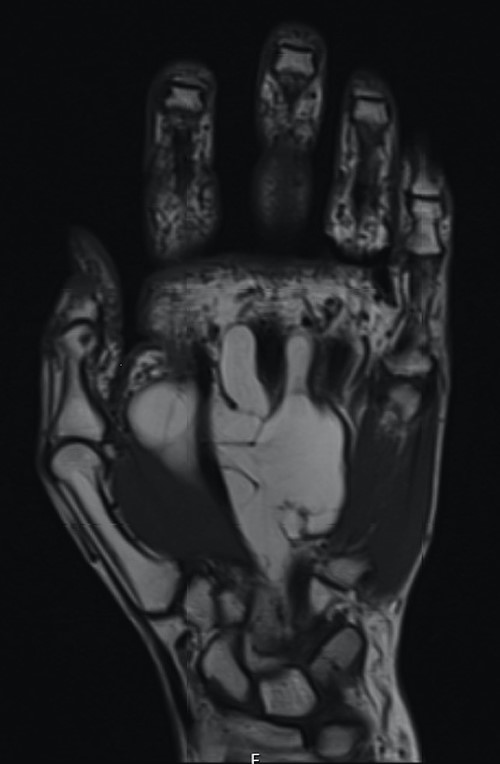 Coronal section demonstrating small proximal extension into carpal tunnel with resultant median nerve compression.