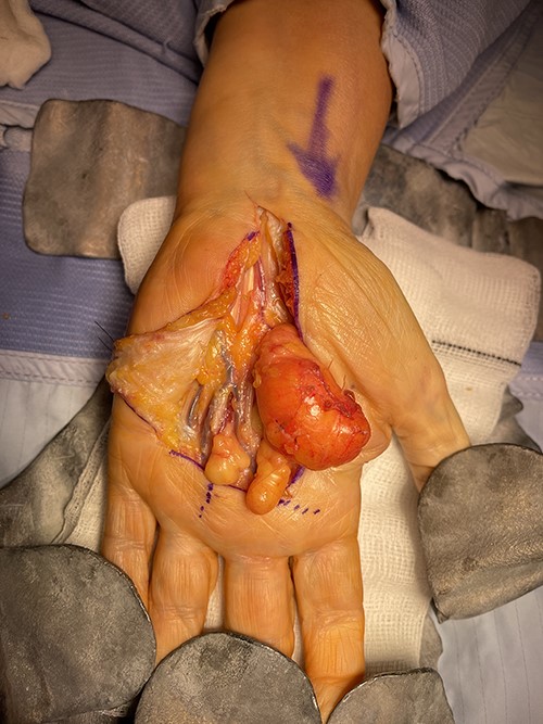 Intraoperative images demonstrating the relationship of the lesion with the surrounding neurovascular structures.