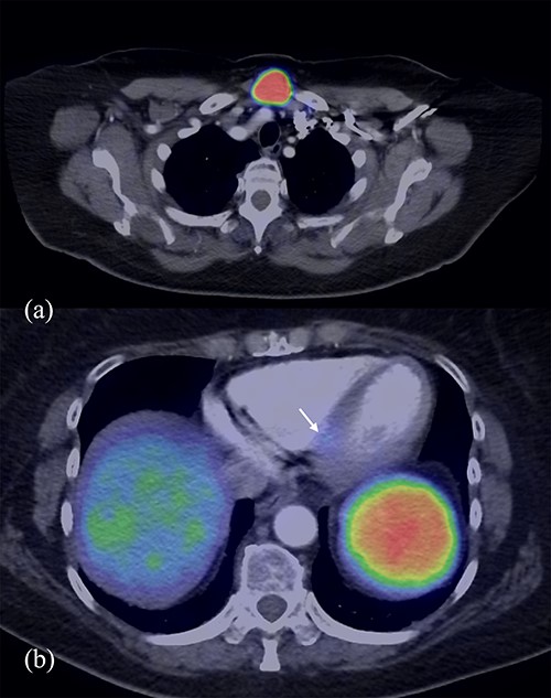 DOTA PET/CT demonstrating avidity in the midline neck mass (a) and the left ventricular septum inferiorly (b).