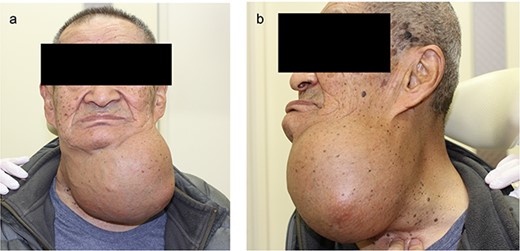 Preoperative photograph (a) frontal view (b) lateral view.