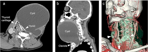 CT scan imaging of the cyst (a, b). The thyroid cartilage pressed toward the right side and dislocation of the hyoid bone (c) 3D-imaging of CT scan. Deformed hyoid bone (arrowhead) and pressed thyroid cartilage (arrow).