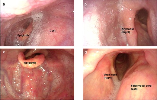 Preoperative endoscopic findings (a, b) before drainage (c, d) after drainage.