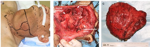 Pre- and intraoperative photographs (a) preoperative photographs (b) intraoperative photograph (c) extracted thyroglossal duct cyst.