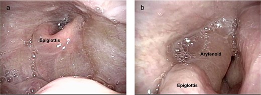 Postoperative endoscopic findings.
