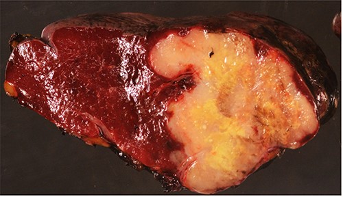 Surgical specimen: splenectomy; macroscopically, neoplastic retraction of the splenic capsule corresponding with a nodular, well-circumscribed, whitish neoplasm, 45 mm in diameter; parenchymatous resection margins are intact.