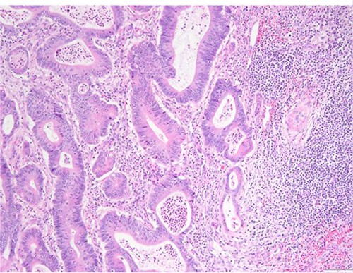 Surgical specimen: splenectomy; microscopy, HE; spleen parenchyma infiltrated by well-formed neoplastic glandular structures composed of cells with ‘pencillated’ and atypical nuclei, with nucleoli, apoptosis and mitotic figures, consistent with an intestinal origin (metastatic colorectal adenocarcinoma).