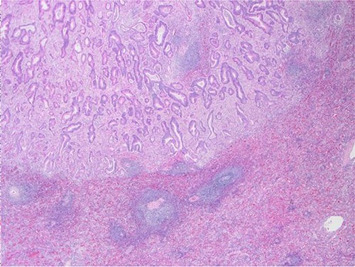 Surgical specimen: splenectomy; microscopy, HE; spleen parenchyma infiltrated by well-formed neoplastic glandular structures composed of cells with ‘pencillated’ and atypical nuclei, with nucleoli, apoptosis, and mitotic figures, consistent with an intestinal origin (metastatic colorectal adenocarcinoma).