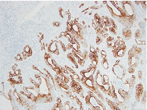 Surgical specimen: splenectomy; immunohistochemistry images: the neoplastic cells express CK20, consistent with an intestinal phenotype.