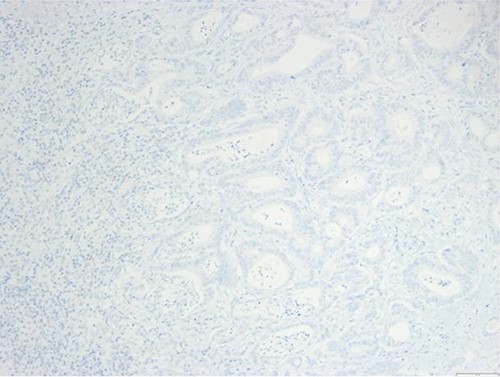 Surgical specimen: splenectomy; immunohistochemistry images: the neoplastic cells do not express CK7, consistent with an intestinal phenotype.
