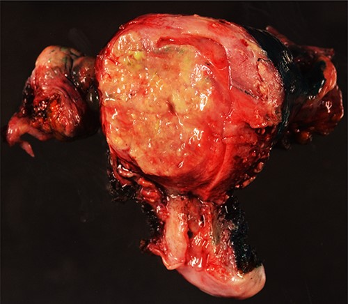 Surgical specimen: hysterectomy; macroscopically, an intramural nodular, yellowish, well-circumscribed neoplastic lesion, 45 mm in diameter, collapsing the endometrial cavity is seen.