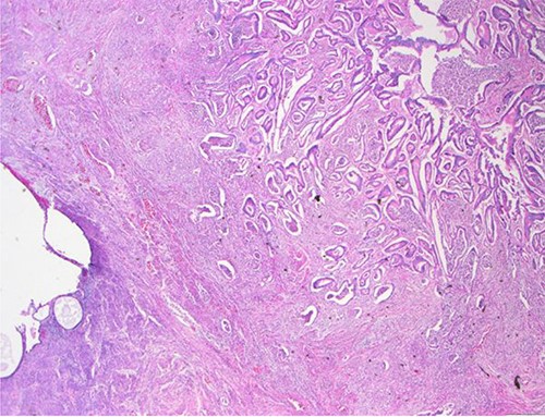 Surgical specimen: hysterectomy; microscopy, HE; endometrium and myometrium infiltrated by well-formed neoplastic glandular structures composed of cells with ‘pencillated’ and atypical nuclei, with nucleoli, apoptosis and mitotic figures, consistent with an intestinal origin (metastatic colorectal adenocarcinoma).