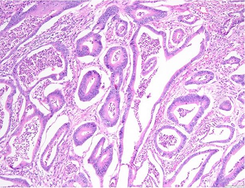 Surgical specimen: hysterectomy; microscopy, HE; endometrium and myometrium infiltrated by metastatic colorectal adenocarcinoma.