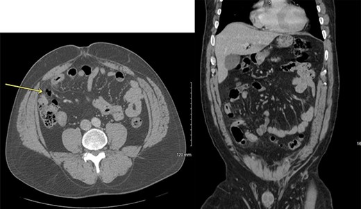 Axial and coronal computed tomography scan views of the patient showing small area of pneumoperitoneum with surrounding small bowel inflammatory changes.