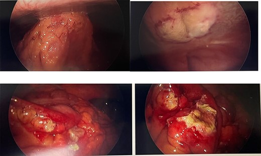 Intraoperative photos. Top right: omentum and small bowel adhered to anterior abdominal wall. Top left: scarred peritoneum after removing adhesion, lateral to medial umbilical ligament. Bottom: small bowel with isolated full-thickness necrosis and perforation and surrounding erythema from thermal injury.