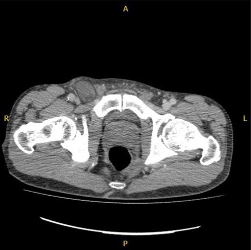 Axial CT image of right De Garengeot hernia.