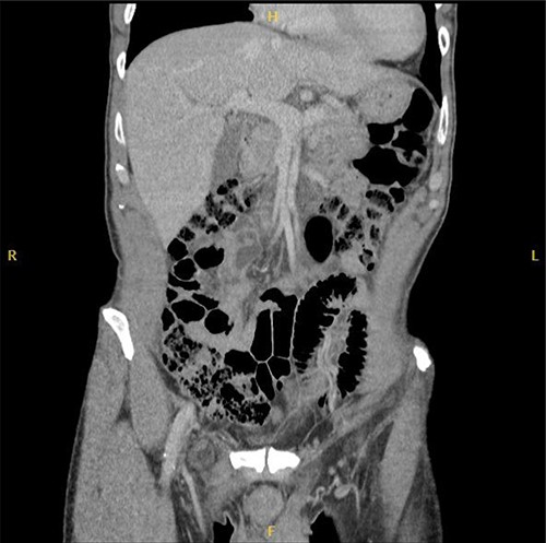 Coronal CT image of right De Garengeot hernia.