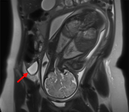 MRI of patient 1 revealing a fluid collection in the right lower abdomen.