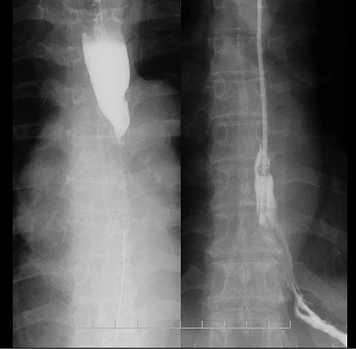 Esophagram findings; the esophagram shows stricture in the middle thoracic esophagus; a nasogastric tube could pass through the stenosis, and tube feeding was started.