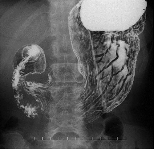CT images showing a horizontal section of the esophagus; CT image shows circumferential wall thickening with infiltrative changes in the middle part of the thoracic esophagus.