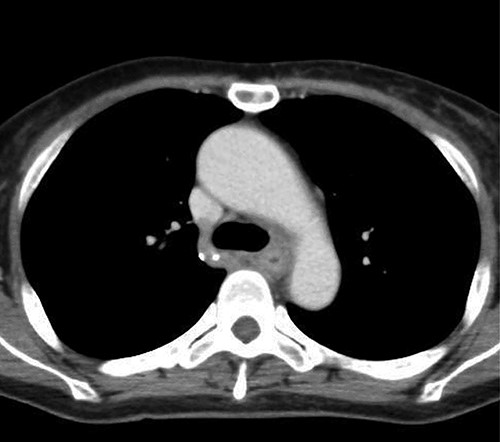 Coronal plane of the CT findings; CT demonstrates dilatation of the upper thoracic esophagus.