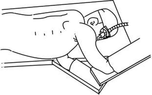 Semi-prone position; in an emergency, this position allows for a rapid transition to the left lateral decubitus position using bed rotation.