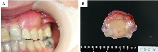 (A) Intraoral examination showing a bulge in the buccal gingiva of the left maxillary canine. (B) Intraoperative findings: a pale yellow explant covered with a membrane.