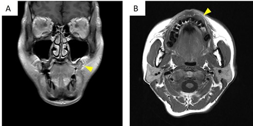 On magnetic resonance imaging, contrast-enhanced T1-weighted images showed a row signal. (A) Frontal cross-section. (B) Horizontal cross-section. The arrowheads indicate the tumor.