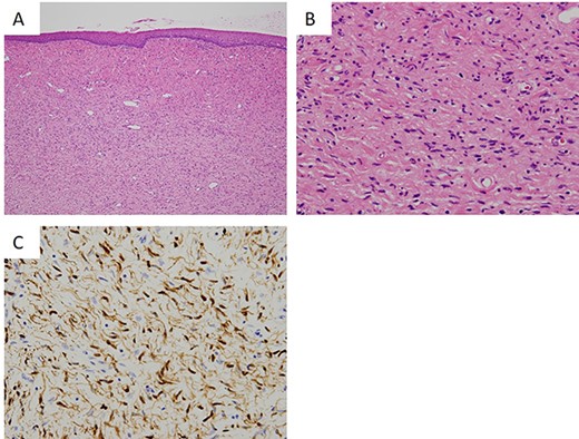 Histopathological findings of the tumor. (A) The lesion is a poorly circumscribed tumor in the submucosal area (hematoxylin and eosin (HE), ×40). (B) Proliferation of elongated and slender cells with round, ovoid and comma-shaped nuclei in a background of sinuous collagen fibers and myxoid matrix (HE, ×200). (C) Immunohistochemical staining of tumor cells showing positivity for S100 (S100, ×200).
