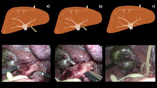 A schematic illustration (a–c) and intraoperative images (d–f) of our operative technique. (a, d) TJL was introduced into the abdominal cavity via an 11 mm port. (b, e) Extra-Glissonian encirclement of the left pedicle. (c, f) The loop was created completely by passing the tail of the catheter through both side-holes of tip of the catheter.