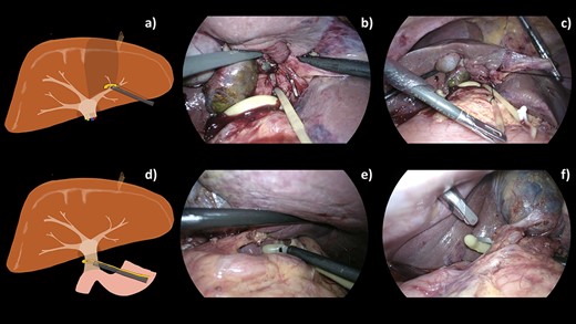 A schematic illustration (a, d) and intraoperative images (b–c, e, f) of our operative techniques for selective control of the segmental pedicle and hepatoduodenal ligament (HDL). (a) Selective extra-Glissonian control of S4 pedicle. (b) Combination of TJL and 2–0 Silk was introduced into abdominal cavity. (c) S4 pedicle was controlled by 2–0 Silk. (d) Encircling of hepatoduodenal ligament. (e, f) Combined 16-Fr urinary catheter with endo mini-retractor for control of the hepatoduodenal ligament.
