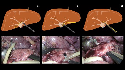Comparative schematic illustrations (a–c) and intraoperative images (d–f) of various techniques attempted for selective encirclement of pedicle by a 10-Fr urinary catheter. (a, d) Feeding the tube to the endo mini-retractor after encircling the pedicle by the retractor making a difficulty in retrieval of the catheter back. (b, e) Piercing the endo mini-retractor through both holes at the tip of the catheter making the catheter prone to slip along the curve of the retractor tip. (c, f) With our technique, the catheter is easily encircling the pedicle.