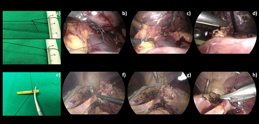 A comparison of intraoperative images of a traditional (a–d) and our technique (e–h) for encircling Glissonian pedicle before stapling or clipping. (a) An extracorporeal adjustable knot was created. (b) The loop was introduced into the abdominal cavity and worn around the neck of the endo mini-retractor. (c) The loop was tightened around the retractor neck. (d) The pedicle was encircled by 2–0 Silk before being stapled. (e) 2–0 Silk was tied to end of the ripped catheter using a basic square knot. (f, g) The combined 10-Fr urinary catheter with endo mini-retractor was used to encircle the pedicle. (h) The pedicle was clipped after being controlled by 2–0 Silk.