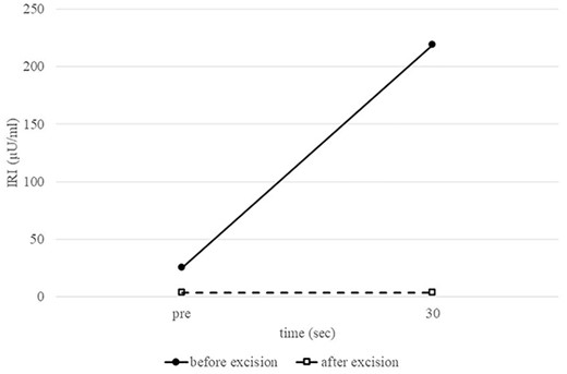 Intraoperative splenic artery SACI test. Comparison of preoperative and postoperative IRI levels after calcium injection into the splenic artery confirms the absence of excessive insulin secretion after tumor removal.