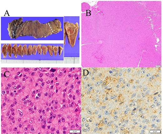 Gross appearance of excised pancreas. (A) Although there was no visible nodule macroscopically, tumor could be detected microscopically in the tail of the pancreas (white arrow). (B) Hematoxylin and eosin staining showed a solid 11-mm nodule without fibrous capsule in the tail of the pancreas. (C) Round to oval nuclei are seen with coarsely clumped chromatin and eosinophilic cytoplasm. (D) Immunostaining for insulin (Agilent, IR002) shows perinuclear Golgi pattern.