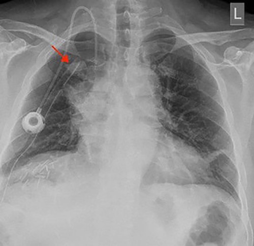 Chest X-ray (PA view) showing the right upper lobe mass. PA: posterior anterior.