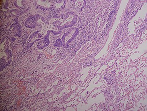 Hematoxylin and eosin stained histopathologic images illustrating lung tissue infiltrated by metastatic adenocarcinoma from colon (hematoxylin–eosin, original magnification ×200).
