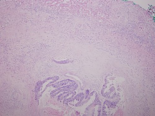 Low magnification power view of liver tissue with metastatic deposit from colon adenocarcinoma. (hematoxylin–eosin original magnification ×100).