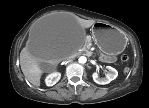 Giant hepatic cyst in the left lobe of the liver.