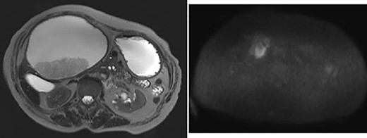 Giant cyst showed high signal intensity on T2-weighted images and fuller component in dorsal side showed high signal on diffusion-weighted images.