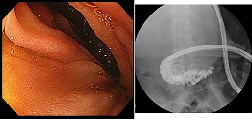 Upper gastrointestinal endoscopy showed severe stenosis of the duodenum.