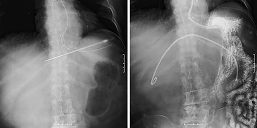 Percutaneous puncture drainage improved the obstruction of duodenum.