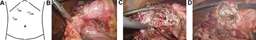 (A) Surgical port arrangement. (B) The wall of the hepatic cyst was tightly adherent to the duodenum. (C) The cyst wall was divided using ultrasonic coagulation incision device. (D) Washing inside the cyst.