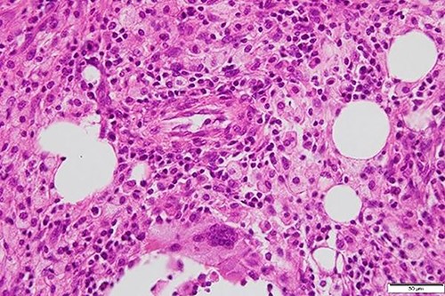 Foamy macrophages and other cells including lymphocytes and plasma cells are present.