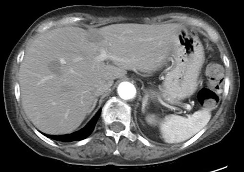 CT scan at 3 months postoperatively showed no recurrence.