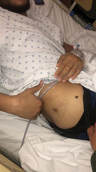 Entry site of the bullet in the superior–posterior aspect of the right gluteal region.