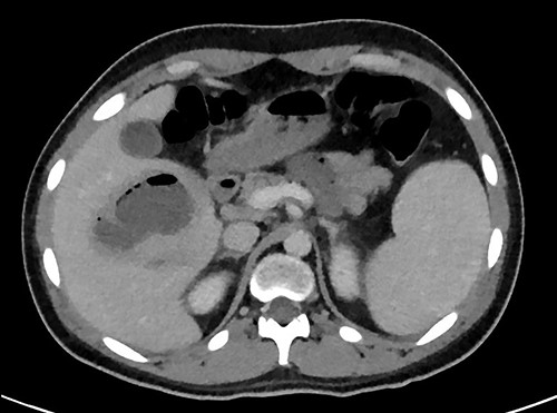 Transverse plane of the CT showing the hepatic collection measuring 8 × 5 cm.