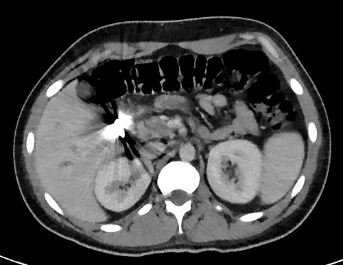 Transverse plan of the CT showed the bullet lodged in segment 5 of the liver.