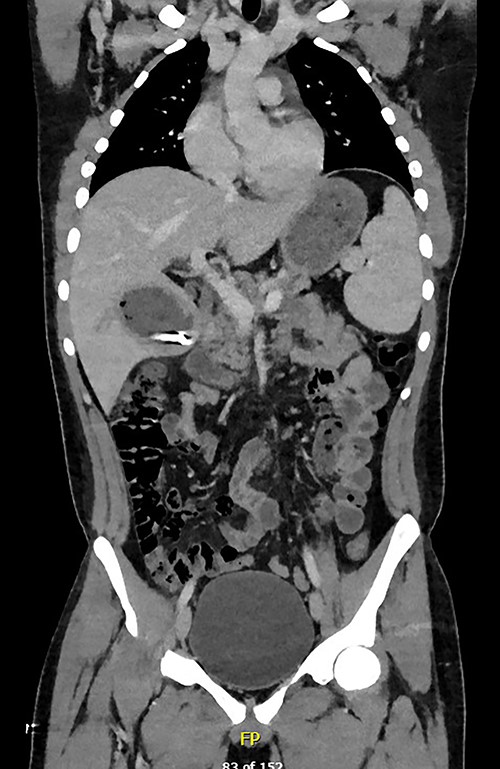 Coronal plane of CT showing the retained bullet and hepatic abscess.