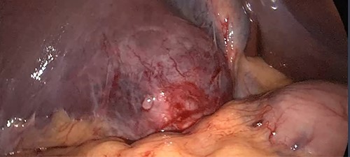 The wall of the hepatic abscess containing the bullet.